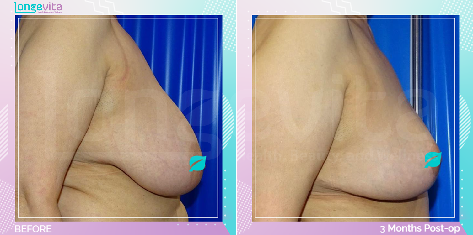 Breast Reduction before and after, Breast