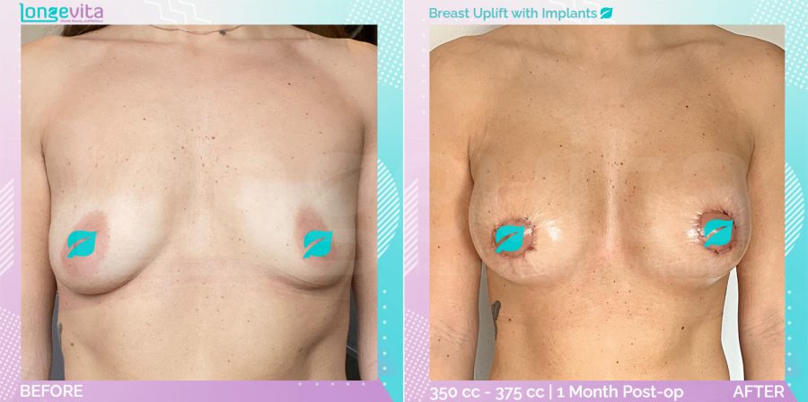 Breast Enlargement and Breast Lift before and after, Breast, 30s female patient