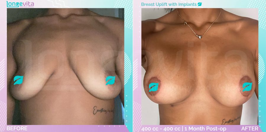 Breast Enlargement and Breast Lift before and after, Breast, 20s female patient