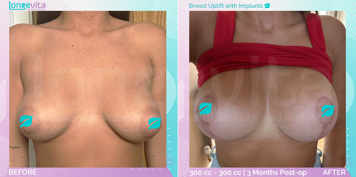 Breast Enlargement and Breast Lift before and after, Breast, 10s female patient
