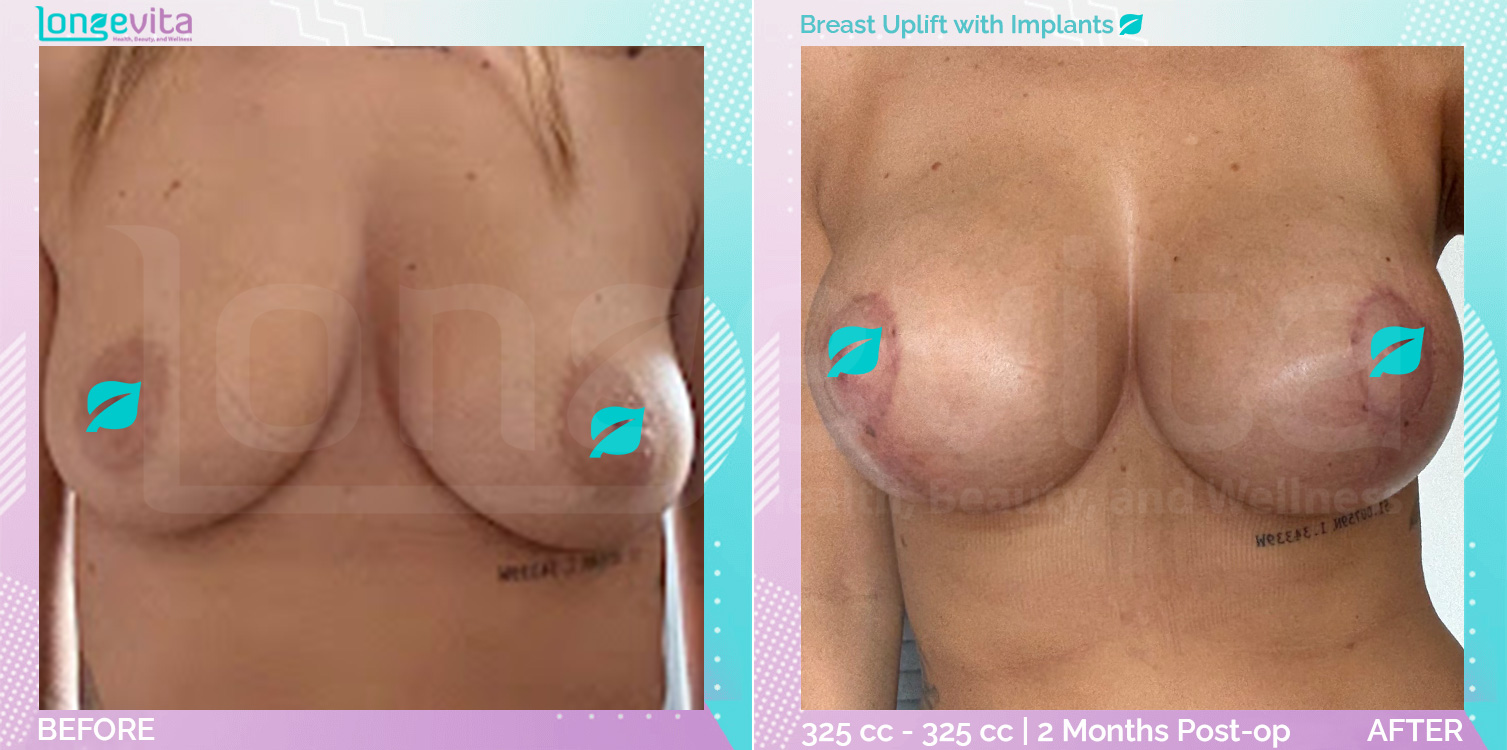 Breast Enlargement and Breast Lift before and after, Breast, 30s female patient