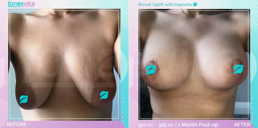 Breast Enlargement and Breast Lift before and after, Breast, 20s female patient