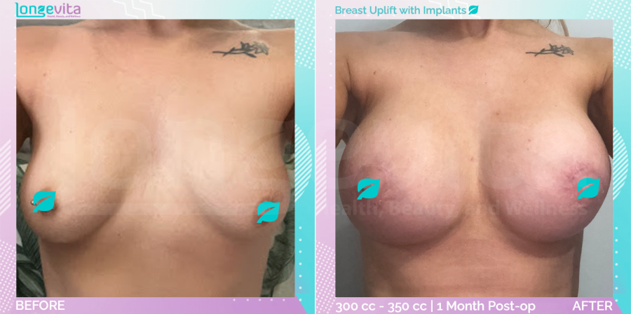 Breast Enlargement and Breast Lift before and after, Breast, 20s female patient