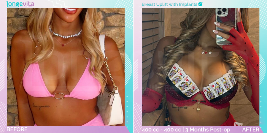 Breast Enlargement and Breast Lift before and after, Breast, 20s female patient
