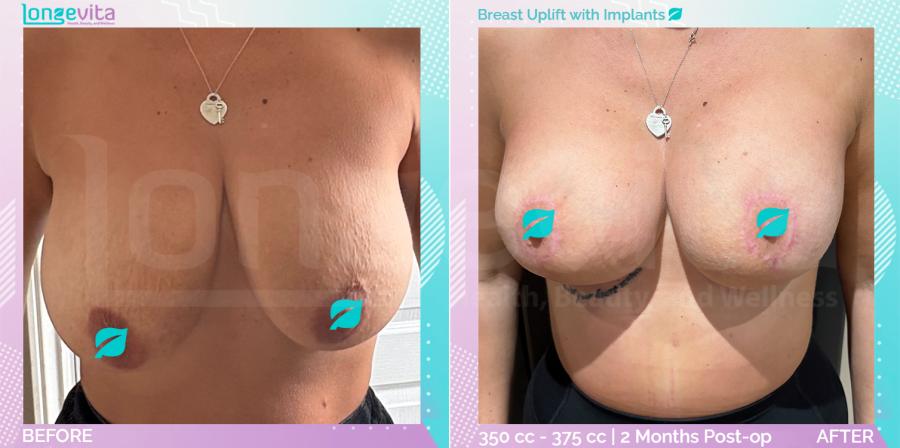 Breast Enlargement and Breast Lift before and after, Breast, 30s female patient