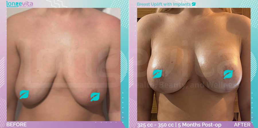 Breast Enlargement and Breast Lift before and after, Breast, 30s female patient