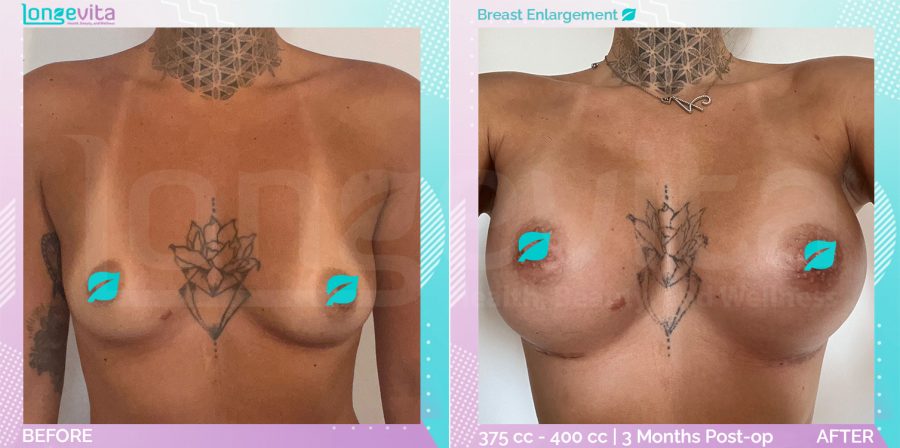 Breast Enlargement before and after, Breast, 20s female patient