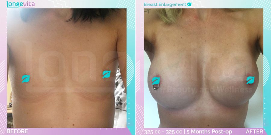 Breast Enlargement before and after, Breast