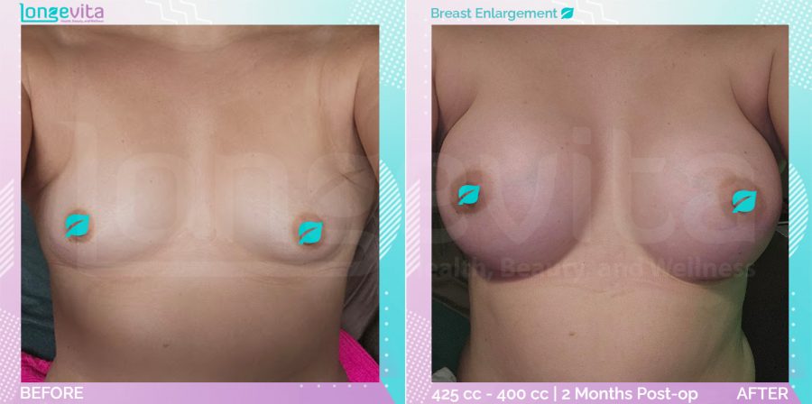 Breast Enlargement before and after, Breast, 30s female patient