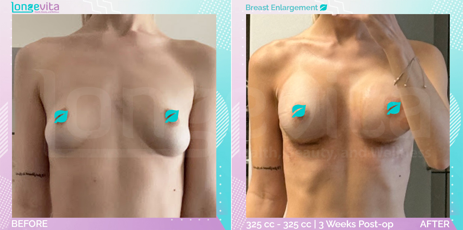 Breast Enlargement before and after, Breast, 20s female patient