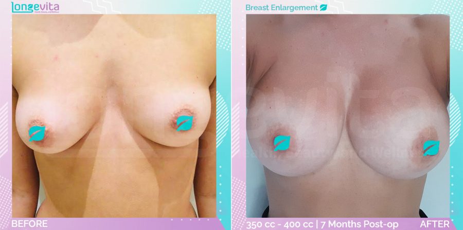 Breast Enlargement before and after, Breast, 30s female patient