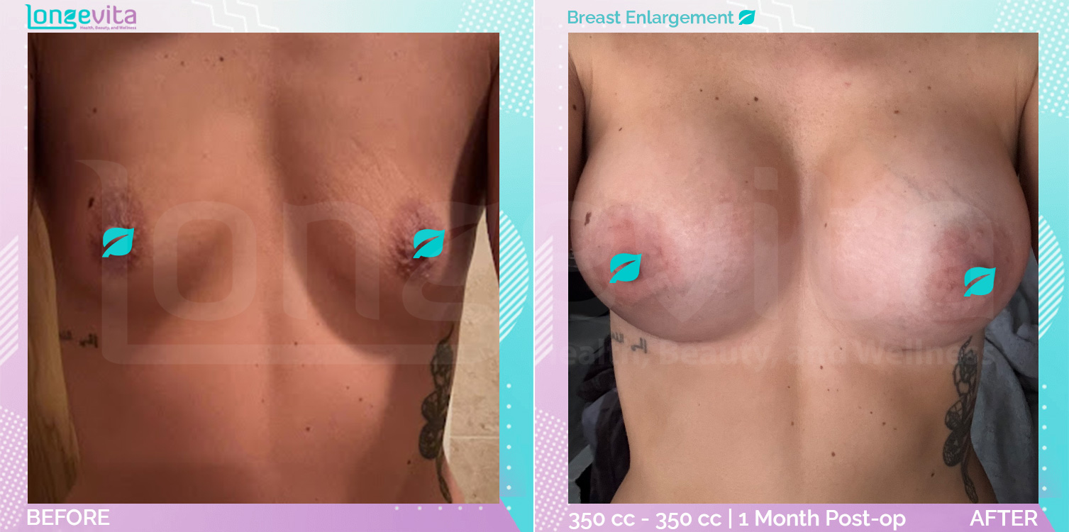 Breast Enlargement before and after, Breast, 20s female patient