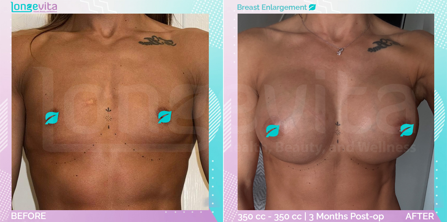 Breast Enlargement before and after, Breast, 30s female patient