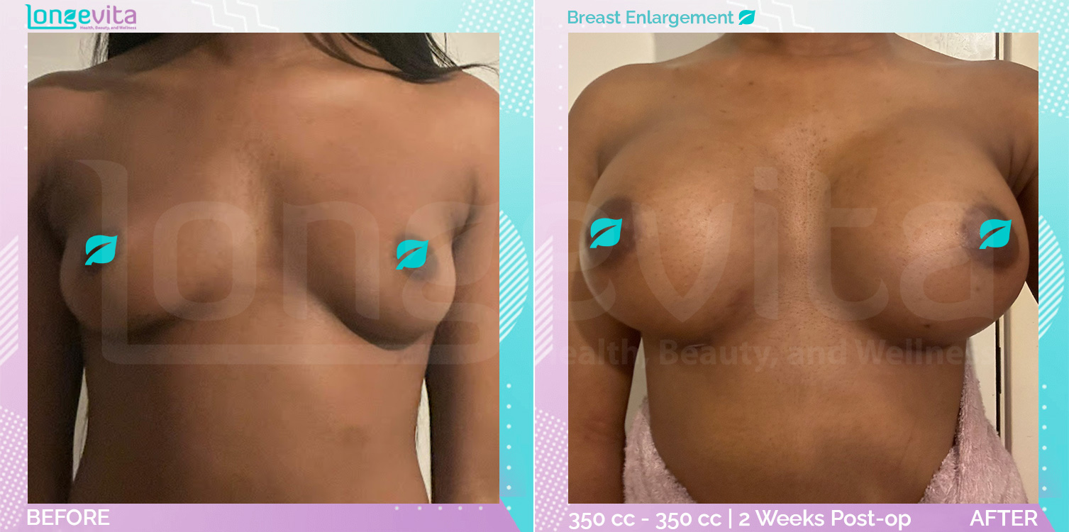 Breast Enlargement before and after, Breast, 20s female patient