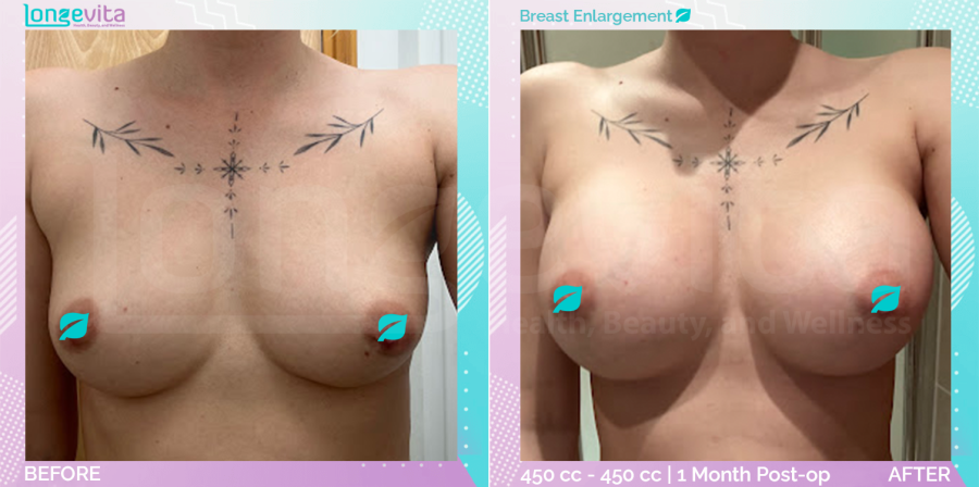 Breast Enlargement before and after, Breast, 20s female patient