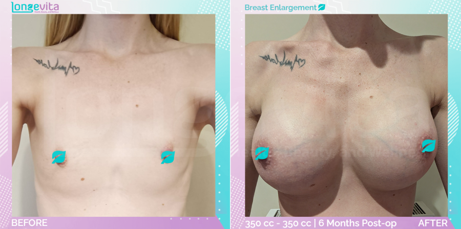 Breast Enlargement before and after, Breast, 20s female patient