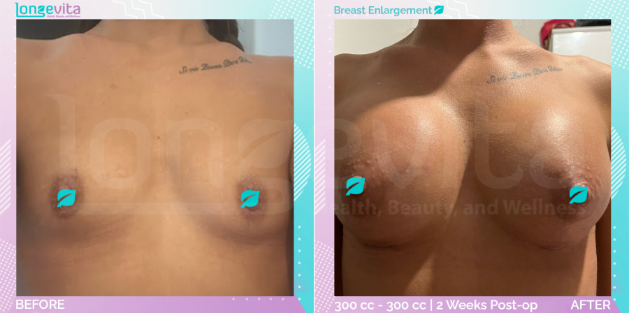 Breast Enlargement before and after, Breast, 30s female patient