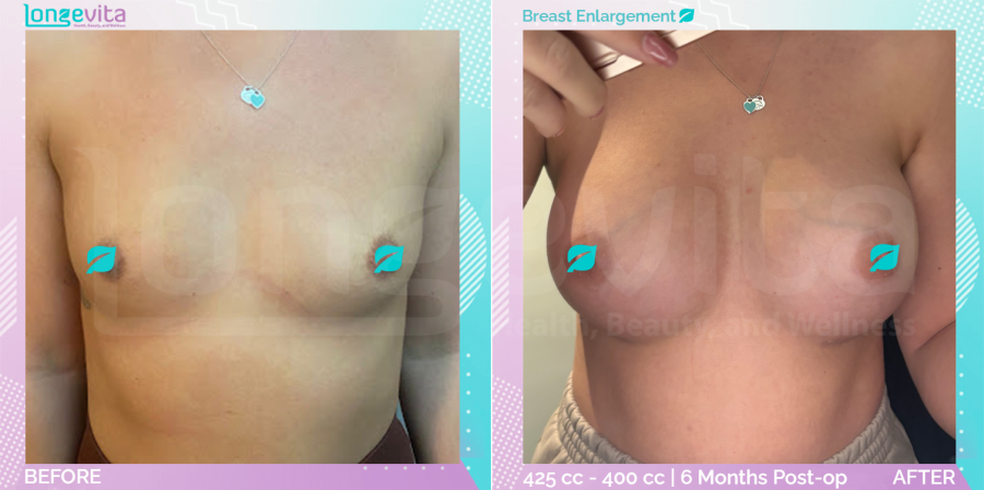 Breast Enlargement before and after, Breast, 30s female patient