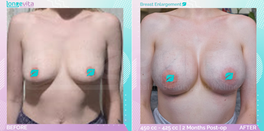 Breast Enlargement before and after, Breast, 30s female patient