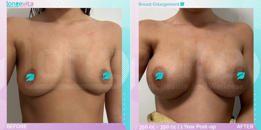 Breast Enlargement before and after, Breast, 20s female patient