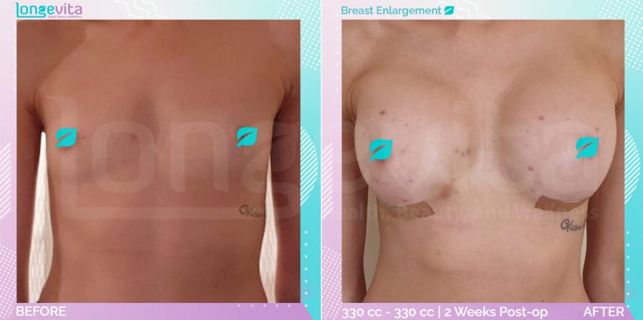 Breast Enlargement before and after, Breast, 20s female patient