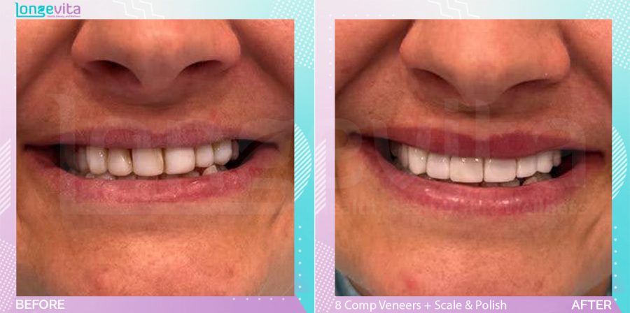 Composite Veneers and Scale and Polish before and after, 8 Composite Veneer & Scale & Polish units, 40s female patient