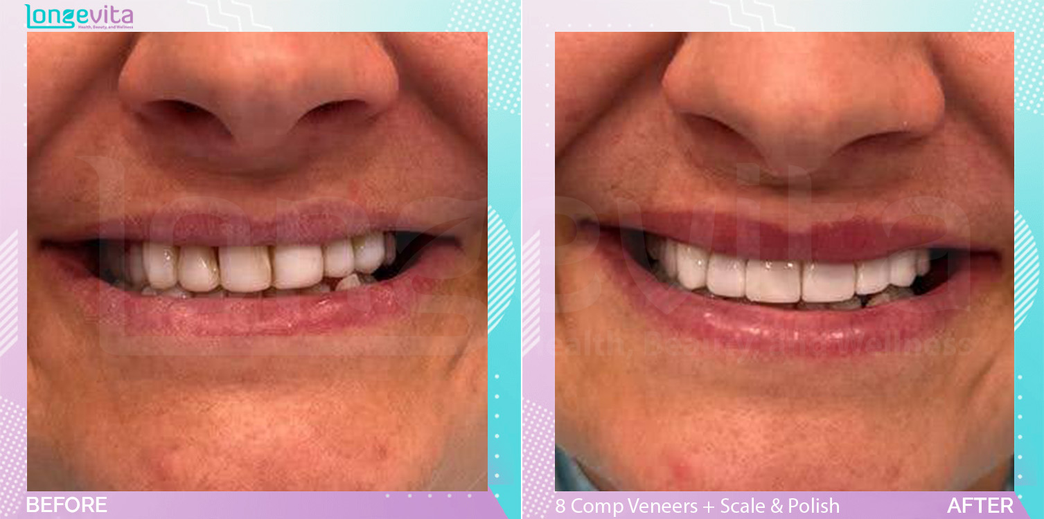 Composite Veneers and Scale and Polish before and after, 8 Composite Veneer & Scale & Polish units, 40s female patient