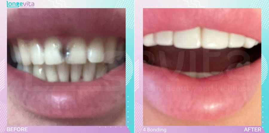 Composite Bonding before and after, 4 Composite Bonding units, 20s female patient