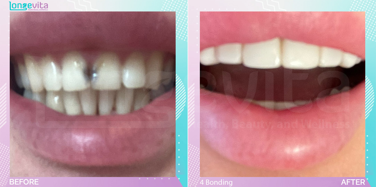 Composite Bonding before and after, 4 Composite Bonding units, 20s female patient