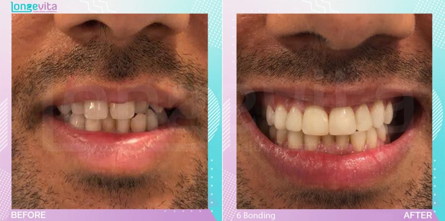 Composite Bonding before and after, 6 Composite Bonding units, 20s male patient