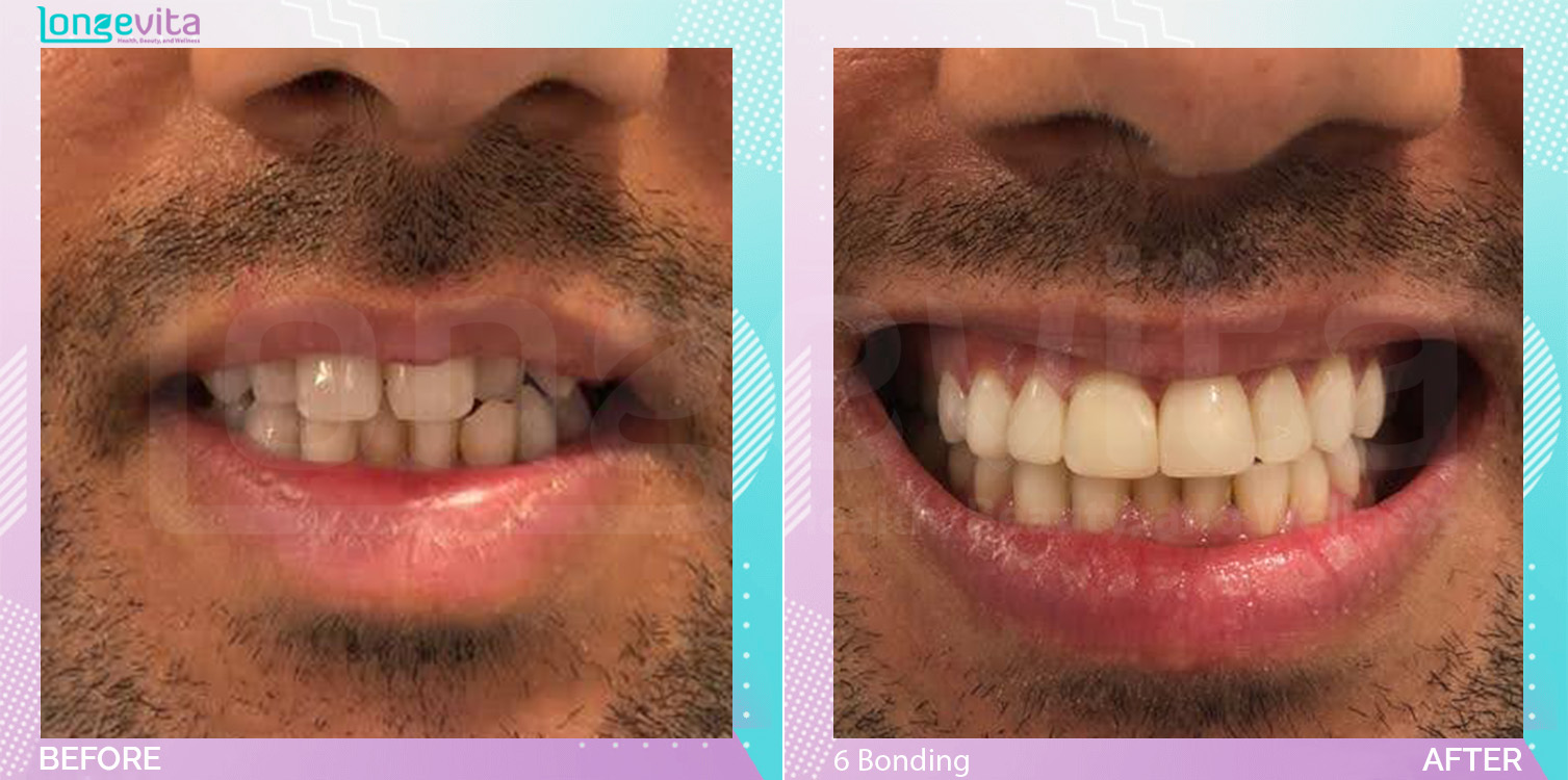 Composite Bonding before and after, 6 Composite Bonding units, 20s male patient
