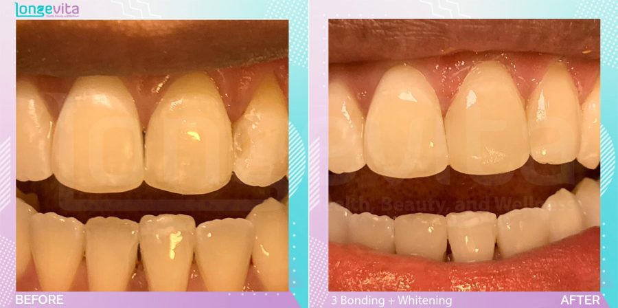 Composite Bonding and Whitening before and after, Teeth Whitening + 3 Composite bonding units, 20s female patient