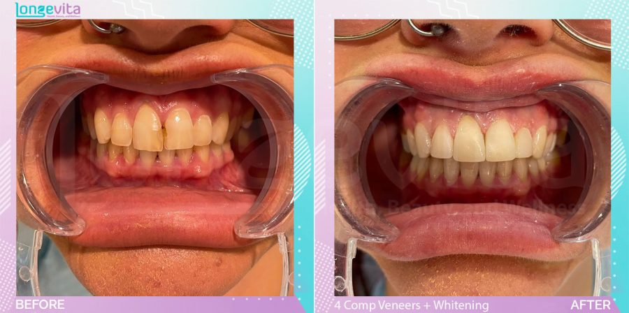 Composite Veneers and Whitening before and after, 4 Composite Veneers + TW units, 20s female patient