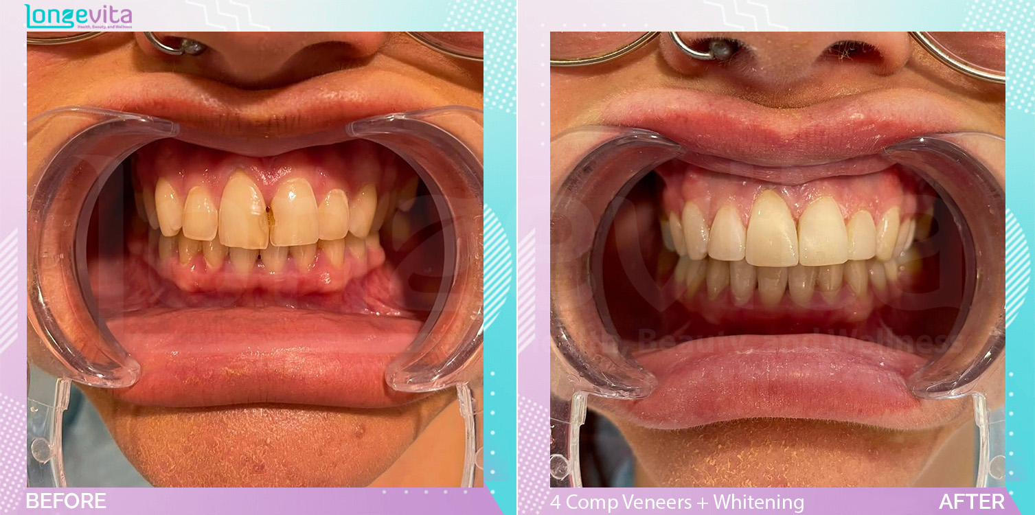 Composite Veneers and Whitening before and after, 4 Composite Veneers + TW units, 20s female patient
