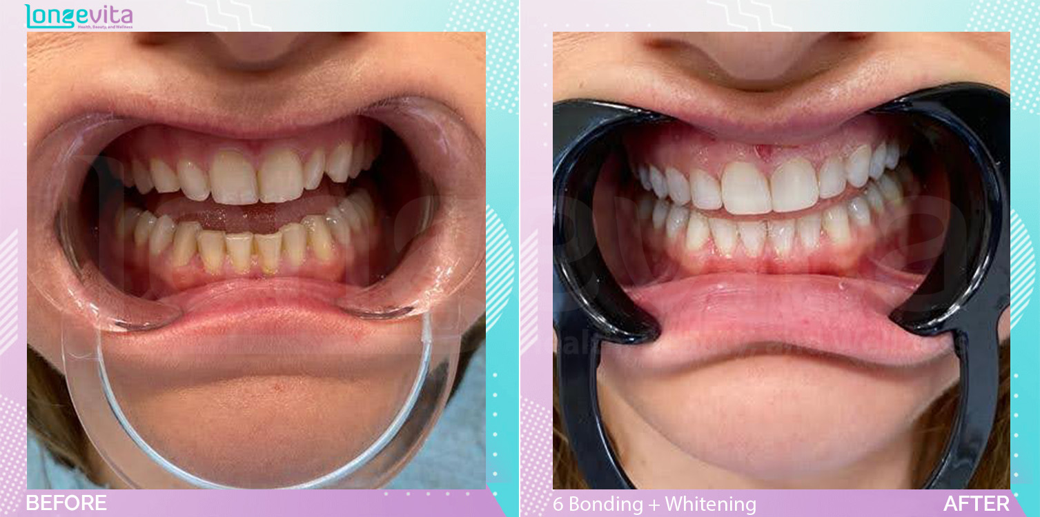 Composite Bonding and Whitening before and after, 6 Composite Bonding + TW units, 20s female patient