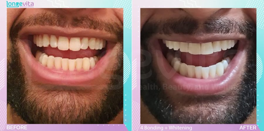 Composite Bonding and Whitening before and after, 4 Composite Bonding+Teeth Whitening units, 20s male patient