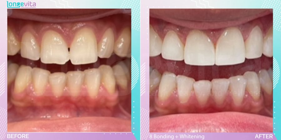Composite Bonding and Whitening before and after, 8 Composite Bonding + Teeth Whitening units, 20s female patient