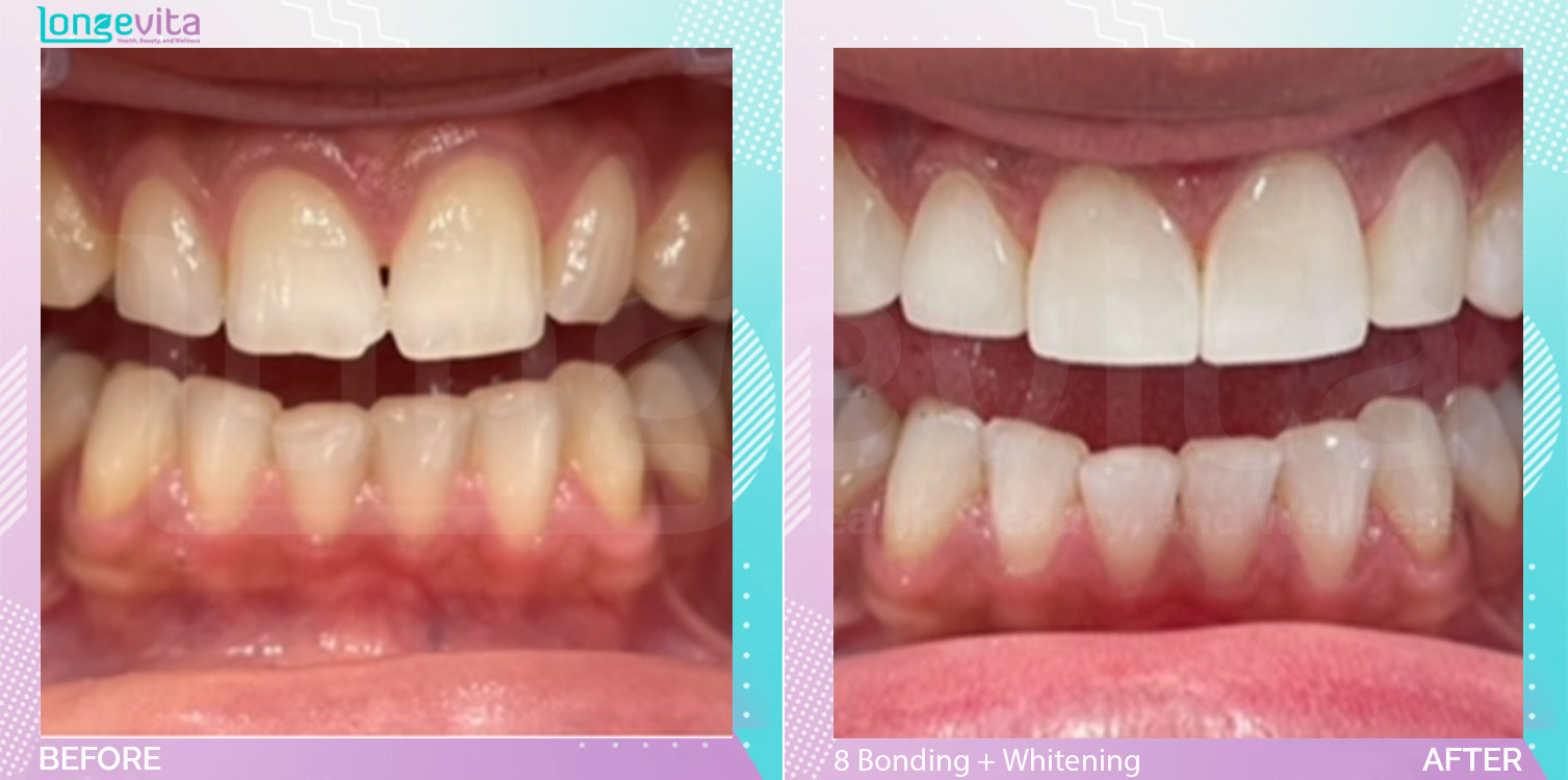 Composite Bonding and Whitening before and after, 8 Composite Bonding + Teeth Whitening units, 20s female patient