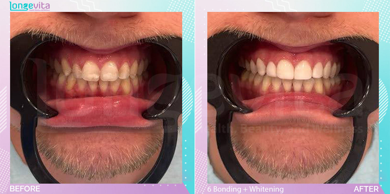 Composite Bonding and Fillings and Whitening before and after, 6 Composite Bonding + Teeth Whitening + filling units, 20s male patient