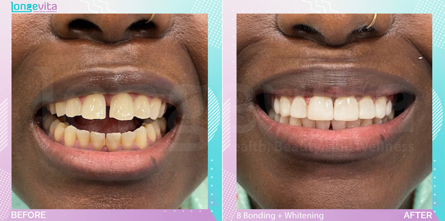 Composite Bonding and Whitening before and after, 8 Composite Bonding + Teeth Whitening units, 20s female patient