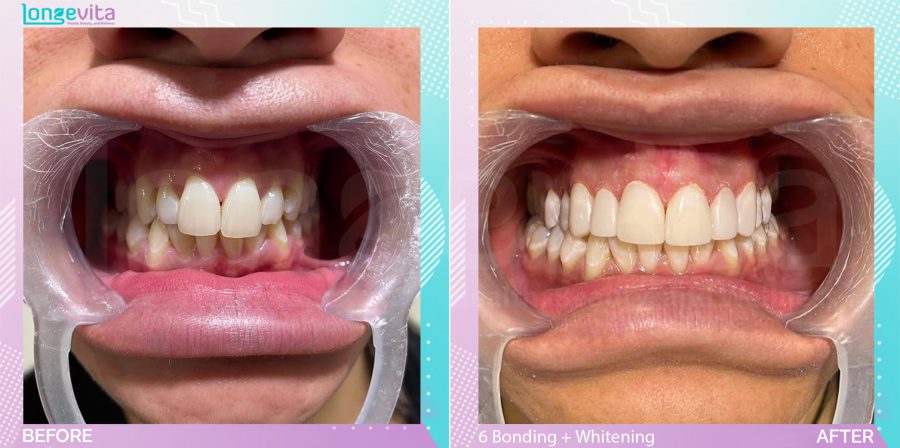 Composite Bonding and Whitening before and after, 6 Composite Bonding + Teeth Whitening units, 20s female patient