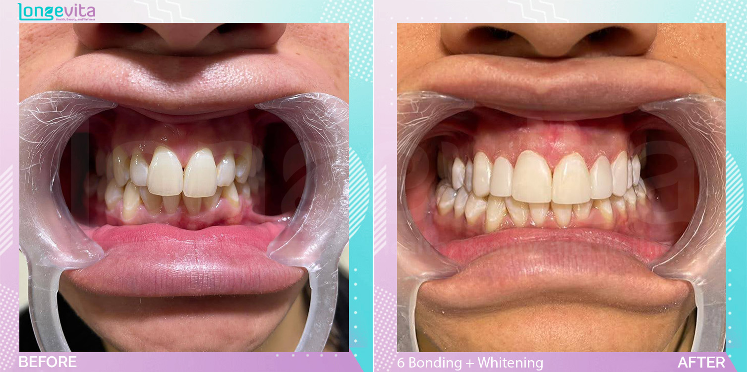 Composite Bonding and Whitening before and after, 6 Composite Bonding + Teeth Whitening units, 20s female patient