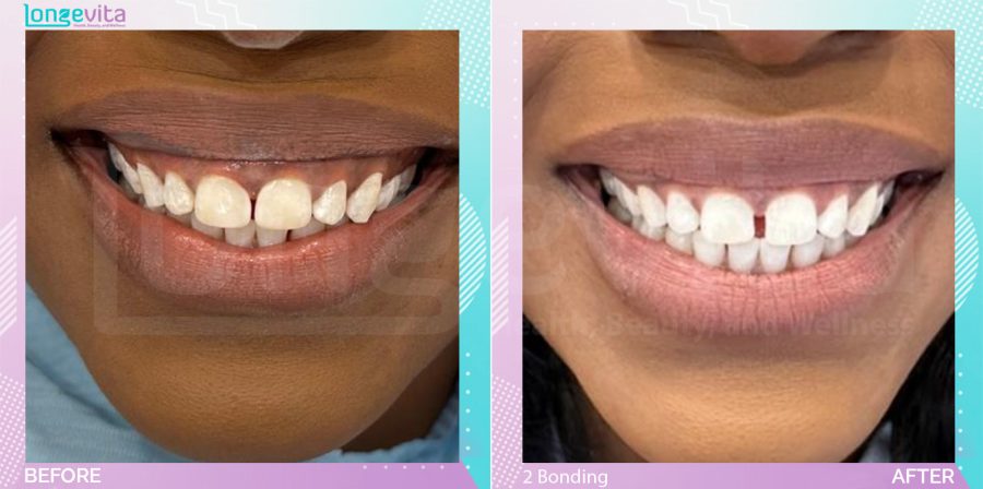 Composite Bonding before and after, 2 Composite Bonding units, 20s female patient