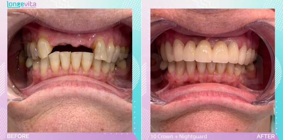 Crowns and Fillings and Nightguard before and after, 10 porcelain Crowns + Nightguard + Filling units, 50s female patient
