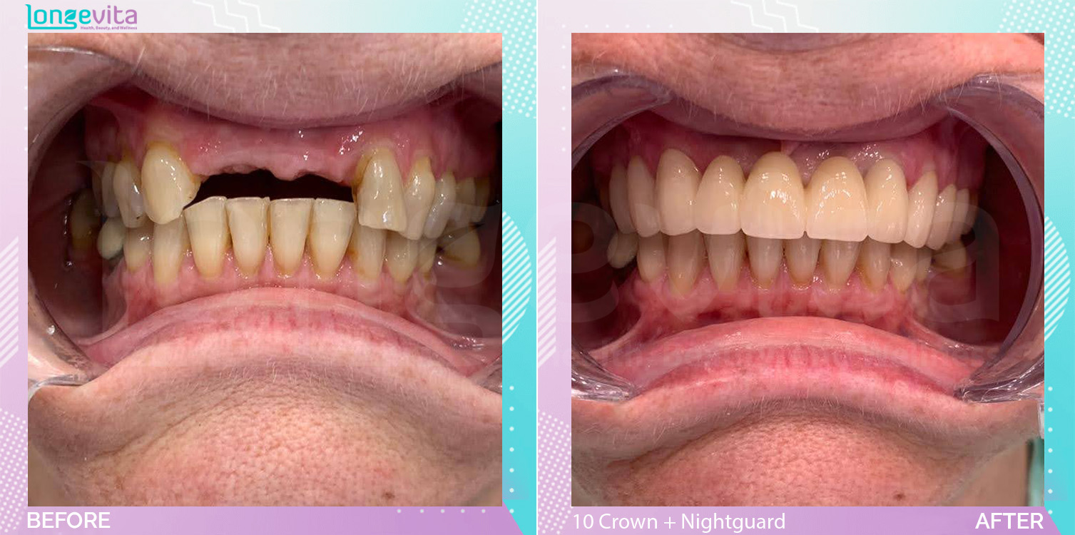Crowns and Fillings and Nightguard before and after, 10 porcelain Crowns + Nightguard + Filling units, 50s female patient