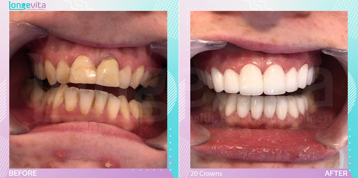 Crowns and Hollywood Smile before and after, 20 Porcelain Crown units, 20s female patient