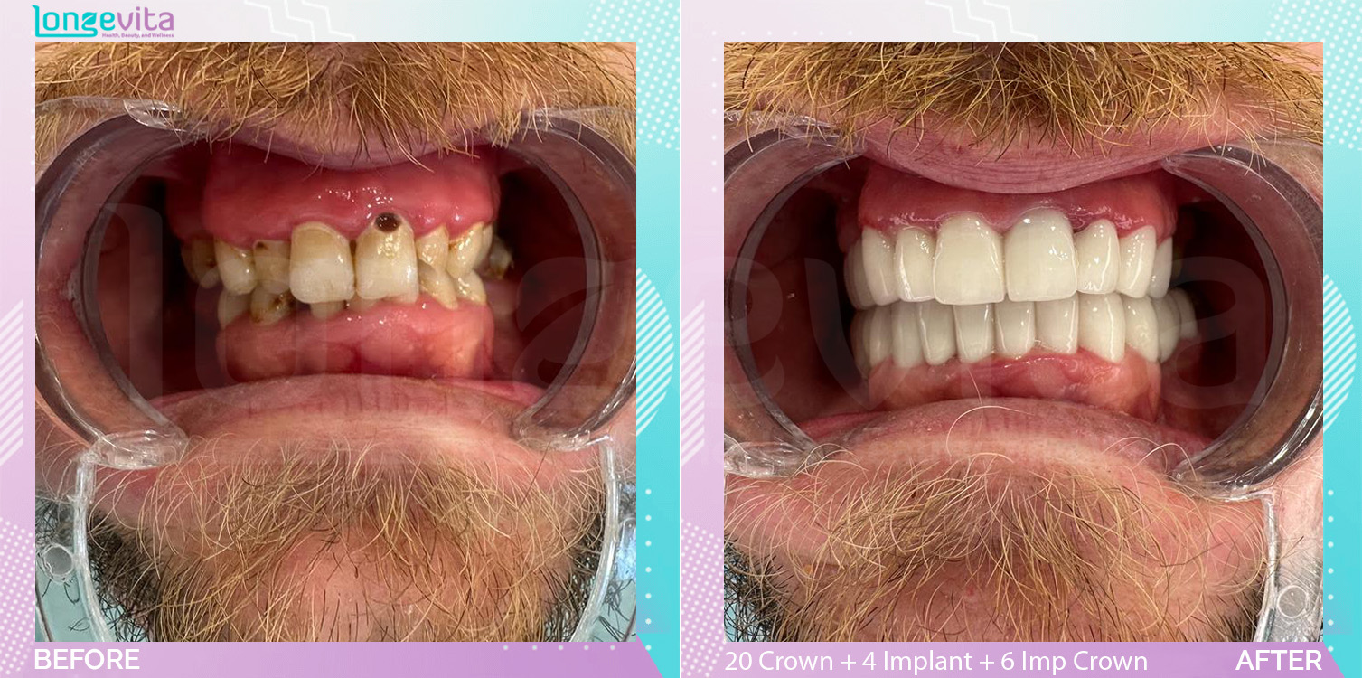 Crowns and Implant Crown and Implants and Root Canal before and after, 20 Porcelain Crown + 4 Implant + 6 Implant Crown + Root Canal + Extraction units, 30s male patient