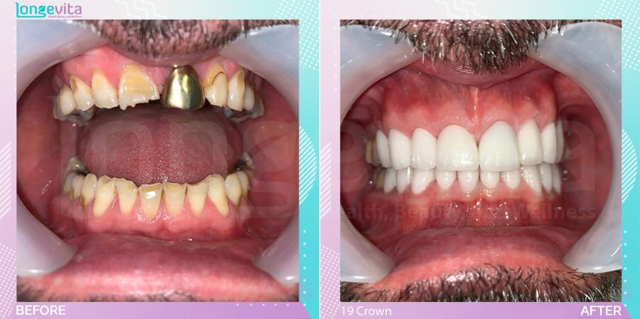 Crowns and Hollywood Smile before and after, 19 Porcelain Crown units, 50s male patient