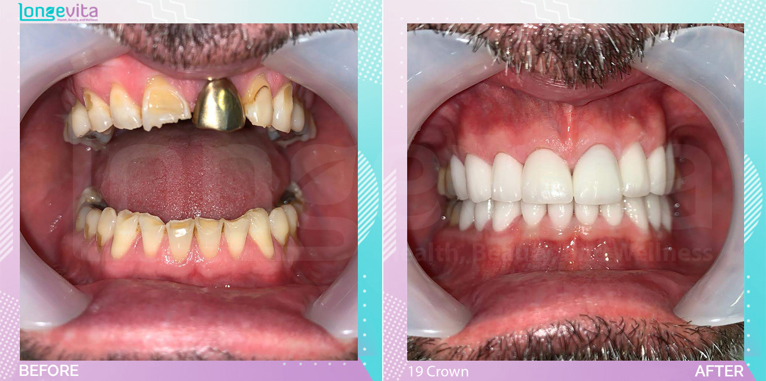 Crowns and Hollywood Smile before and after, 19 Porcelain Crown units, 50s male patient