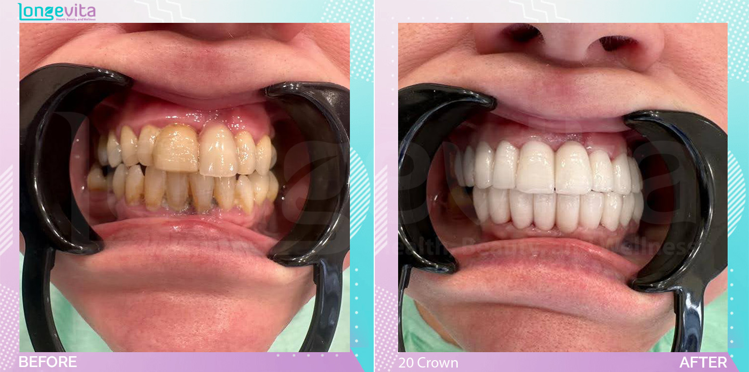 Crowns and Hollywood Smile and Root Canal before and after, 20 Porcelain Crown + 2 Root Canal units